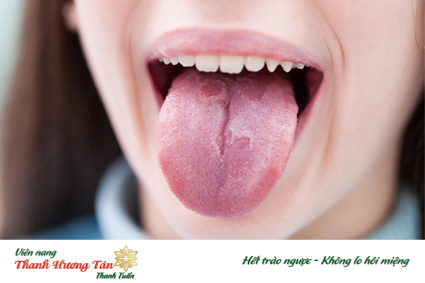Lưỡi bị tưa, sần sùi, nứt nẻ cũng là nguyên nhân bị chua miệng sau khi ăn đồ ngọt