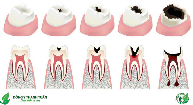 Sâu chân răng phát triển như thế nào?