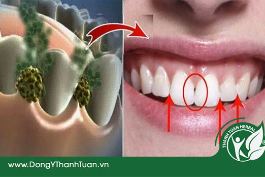 Vệ sinh răng miệng đầy đủ là cách chữa hôi miệng do sâu răng dễ áp dụng