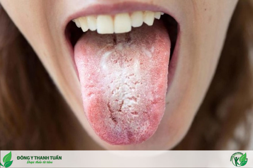 Miệng đắng và hôi là dấu hiệu của bệnh răng miệng